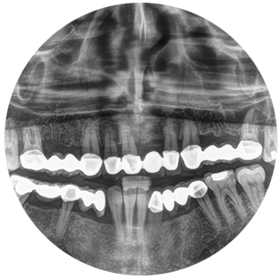 Full Mouth X-rays